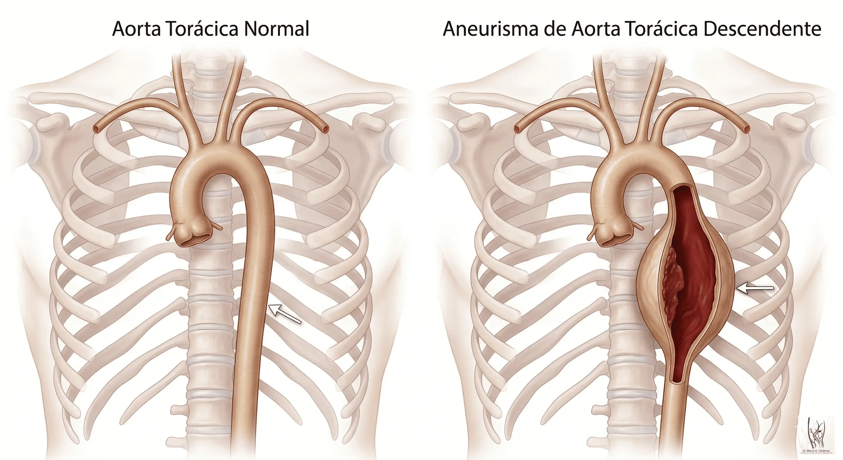 Aneurisma Aorta Torácica